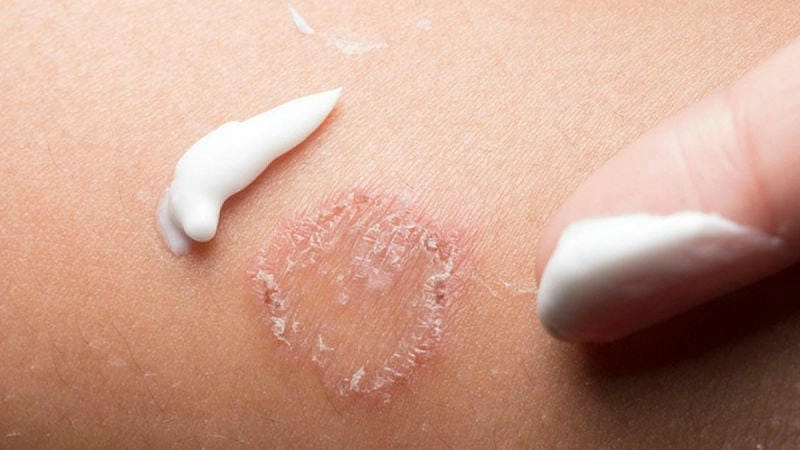 Cảnh báo sớm tình trạng bé sơ sinh bị hắc lào nguy hiểm