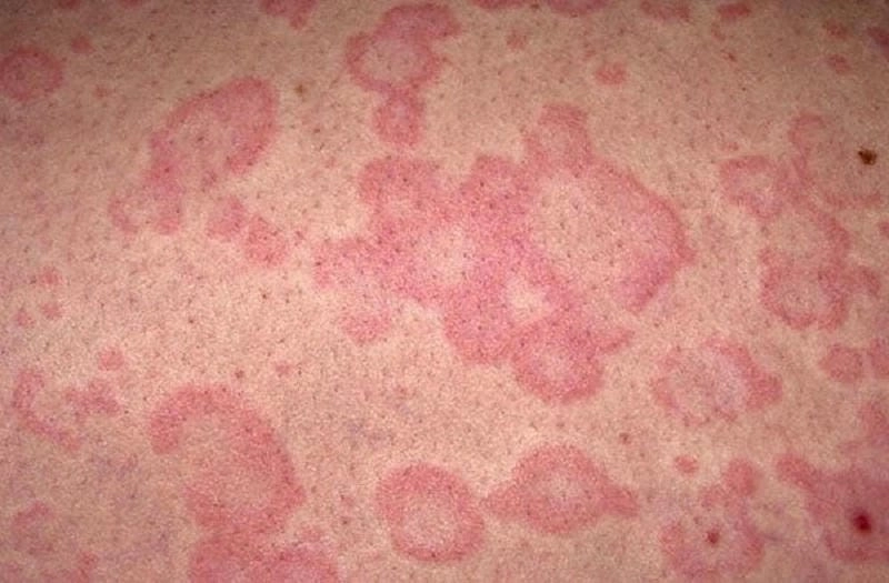 Cảnh báo mức độ nguy hiểm qua hình ảnh hắc lào nặng