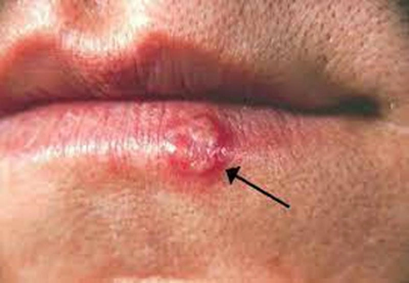 Bộ sưu tập hình ảnh bệnh herpes ở người sống động