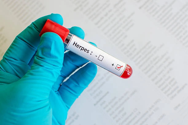 Cập nhật ảnh mới nhất về bệnh herpes da ngoài da