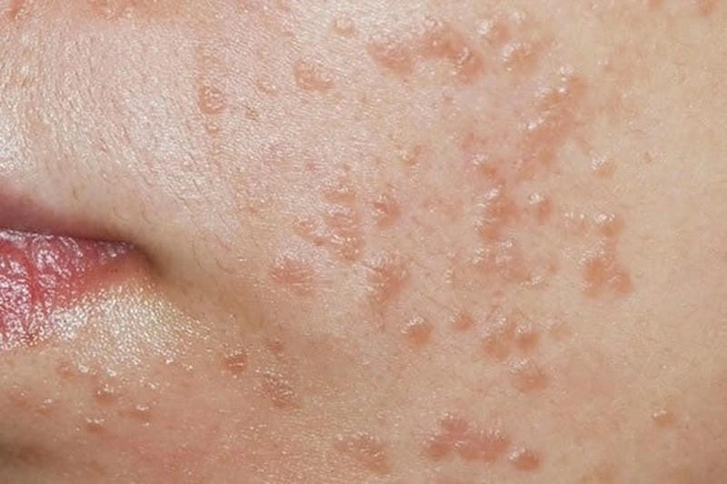 Xem bộ sưu tập ảnh bệnh hồng ban đa dạng chân thực
