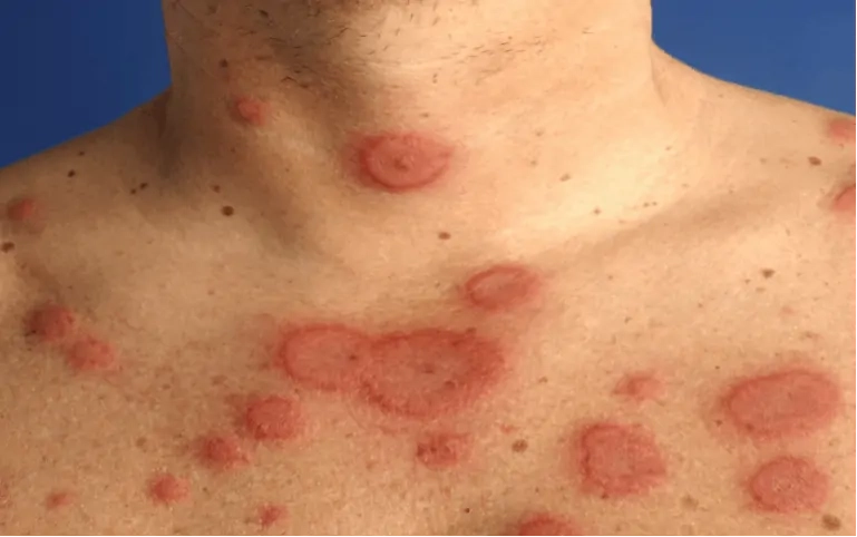 Nhận biết hồng ban đa dạng nặng và cảnh báo nguy hiểm