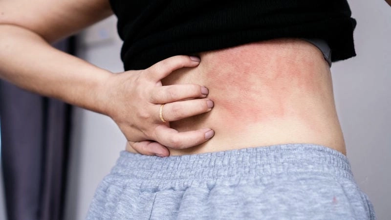 Hình thật hình ảnh người bị bệnh hồng ban đa dạng chuẩn xác