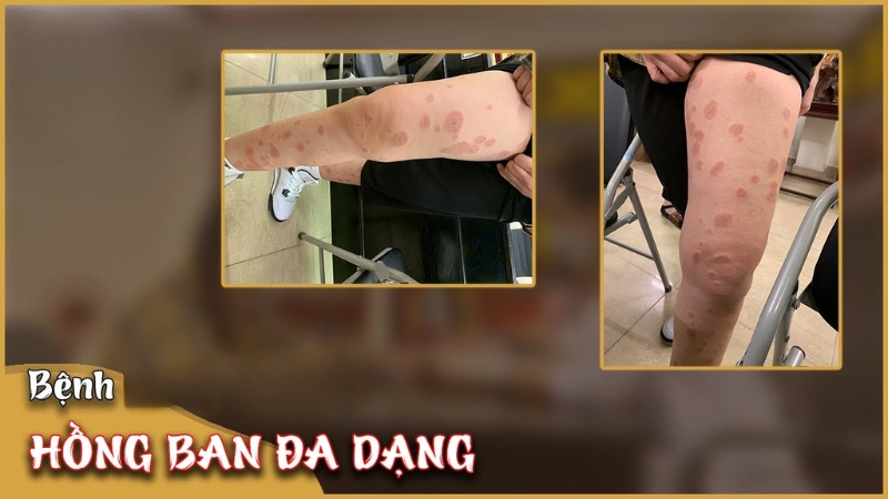 Tổng hợp hình ảnh bệnh hồng ban đa dạng trên cơ thể người