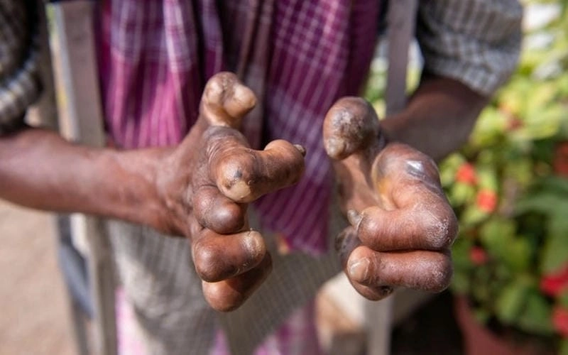 Tìm hiểu thực hư bệnh hủi có lây không qua hình