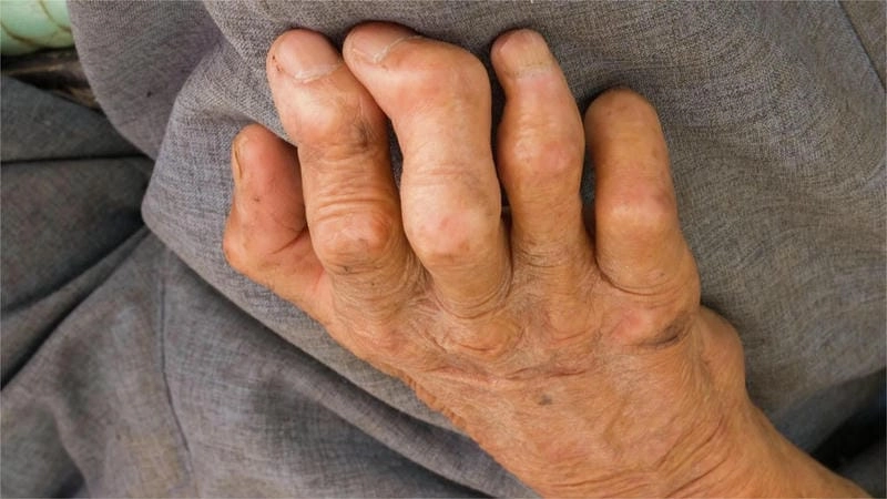 Cập nhật kiến thức về bênh phong hủi qua ảnh