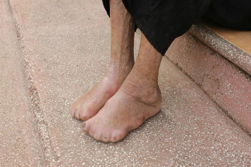 Hình ảnh chân thực về bệnh phong hủi hiện nay