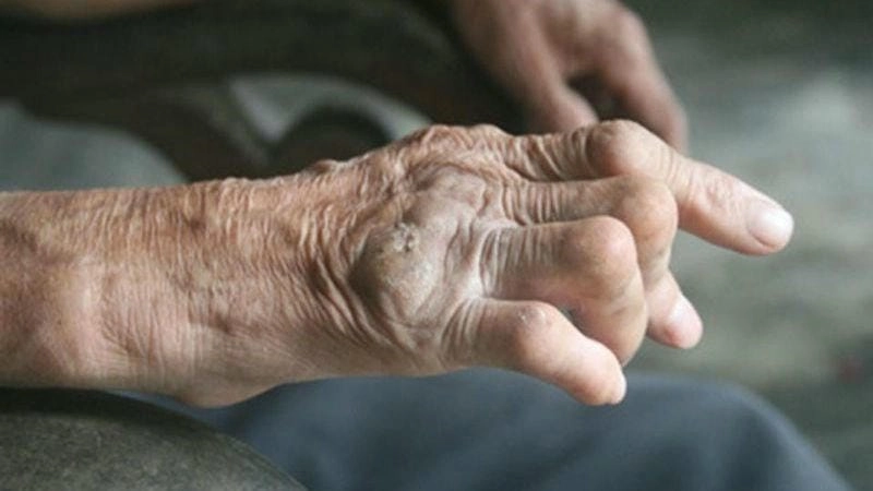 Hình ảnh cuộc sống người bị bệnh hủi hiện nay