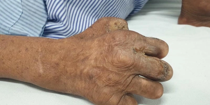 Hồi tưởng lịch sử qua bệnh hủi ngày xưa