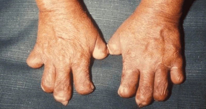 Nhìn cận cảnh hình ảnh bệnh hủi rõ nét