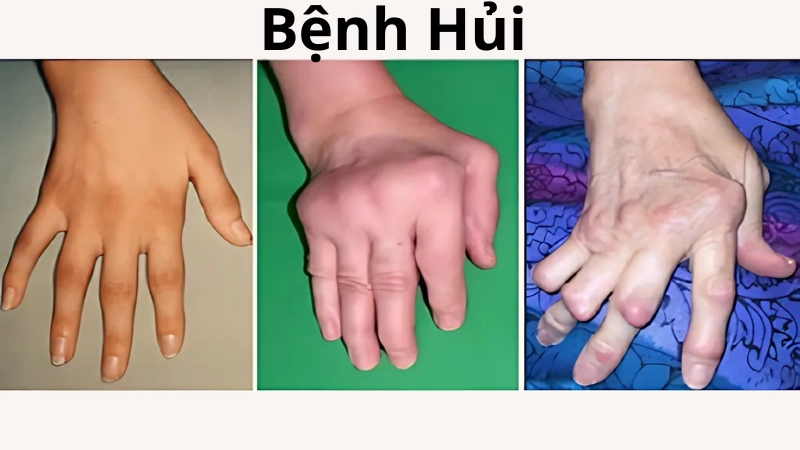 Tổng hợp hình ảnh bệnh hủi chi tiết từ nhẹ đến nặng