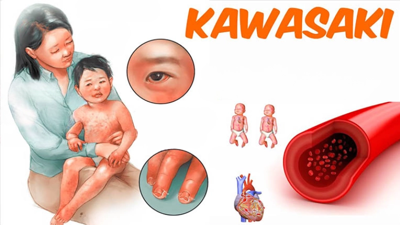 Hình ảnh bệnh Kawasaki giúp chẩn đoán sớm hiệu quả