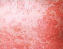 Tổng hợp ảnh lang beng đỏ ở người được xác thực