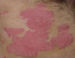 Triệu chứng da liễu thường thấy ở lang beng đỏ