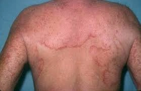 Hướng dẫn kiểm tra y tế liên quan bệnh lang beng đỏ