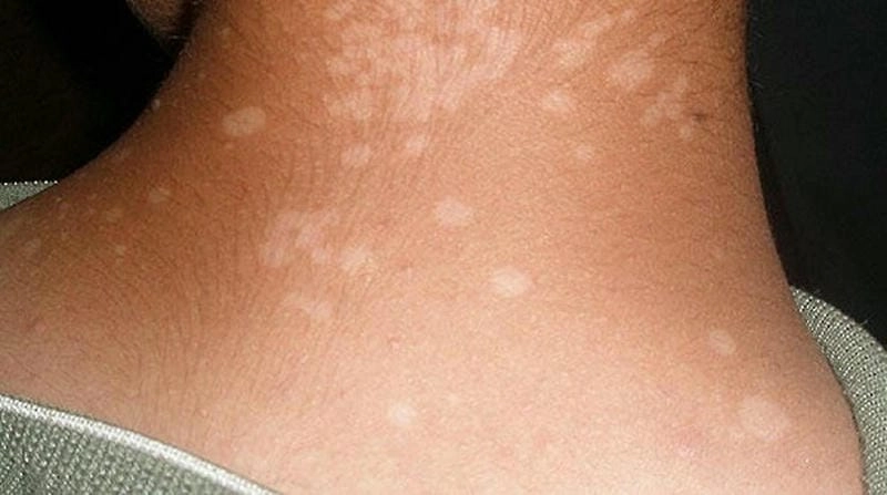 Nhận biết sớm hình ảnh lang beng nâu ở da