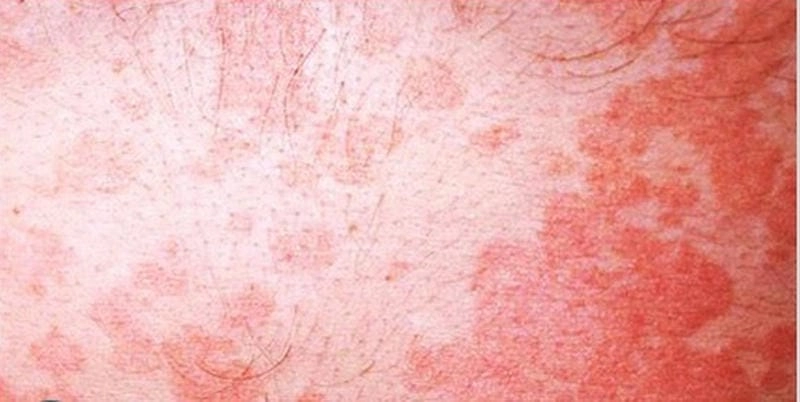 Nhận biết triệu chứng của bệnh lang beng đỏ nhanh