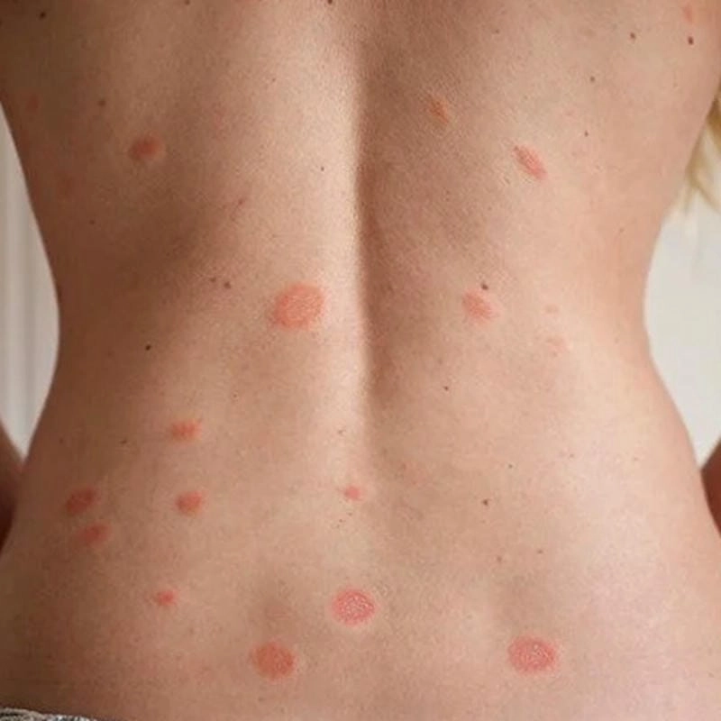 Cách phòng ngừa hiệu quả khi bị lang beng đỏ