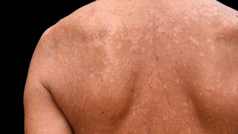 Phân biệt bệnh hắc lào lang beng đỏ và nấm da