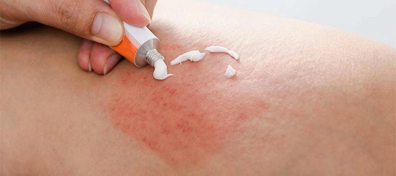 Tìm hiểu nguyên nhân vì sao dễ bị lang beng đỏ
