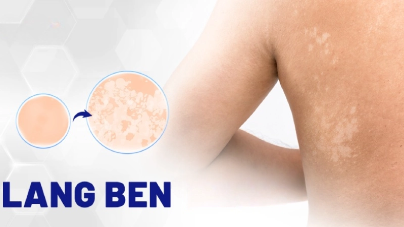 Nhận biết sớm qua hình ảnh bệnh lang beng phổ biến