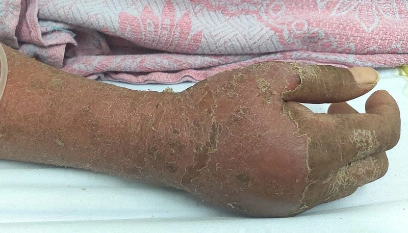 Giải đáp thắc mắc bệnh lao da có lây không kèm ảnh mô tả