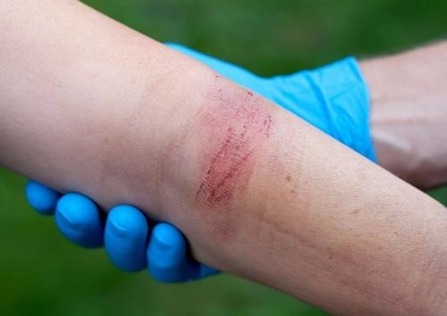 Cập nhật triệu chứng bằng hình ảnh người bị lao da rõ ràng