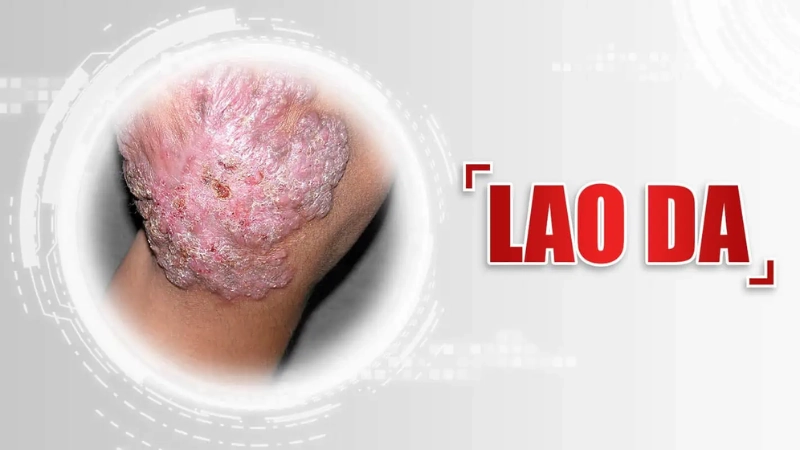 Tổng hợp hình ảnh bệnh lao da qua các giai đoạn thường gặp