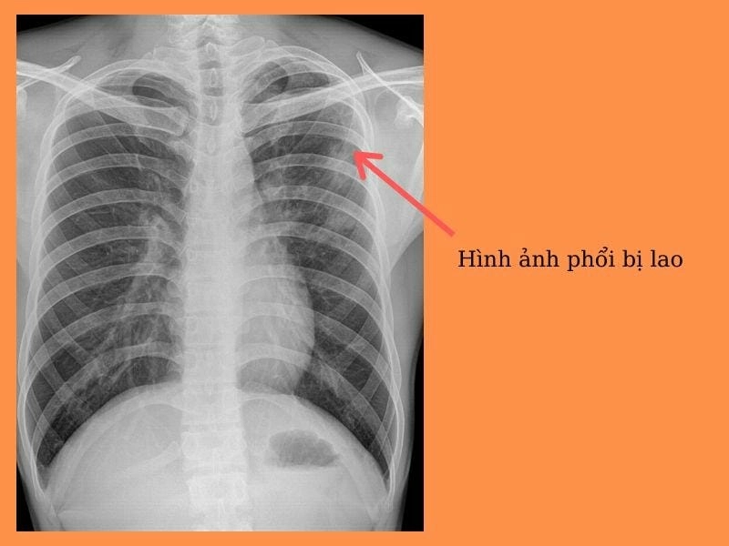 Tổng hợp nổi bật hình ảnh phổi bị lao thực tế