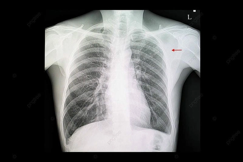 Cập nhật nhanh chóng hình ảnh lao phổi đa dạng