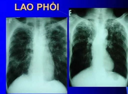 Tổng hợp đầy đủ hình ảnh lao phổi mới nhất