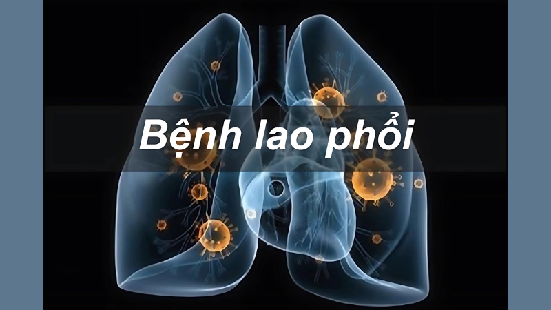Hình ảnh bệnh lao phổi thực tế từ phim chụp X-quang
