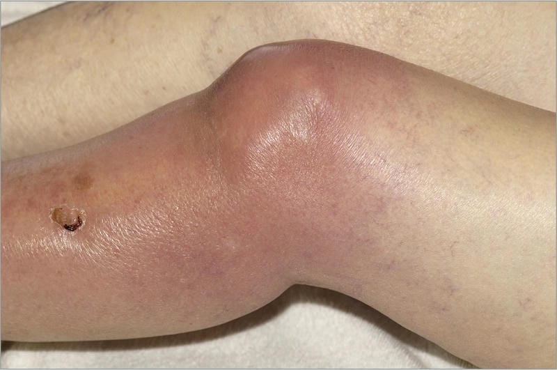 Tổng hợp bệnh lậu hình ảnh đáng chú ý cho người mới