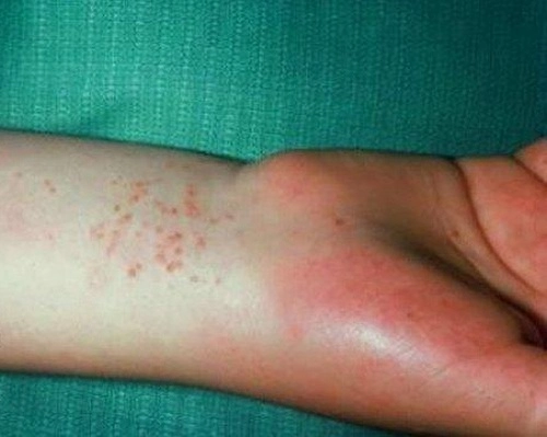 Phát hiện sớm nhờ hình ảnh bị bệnh lậu phổ biến