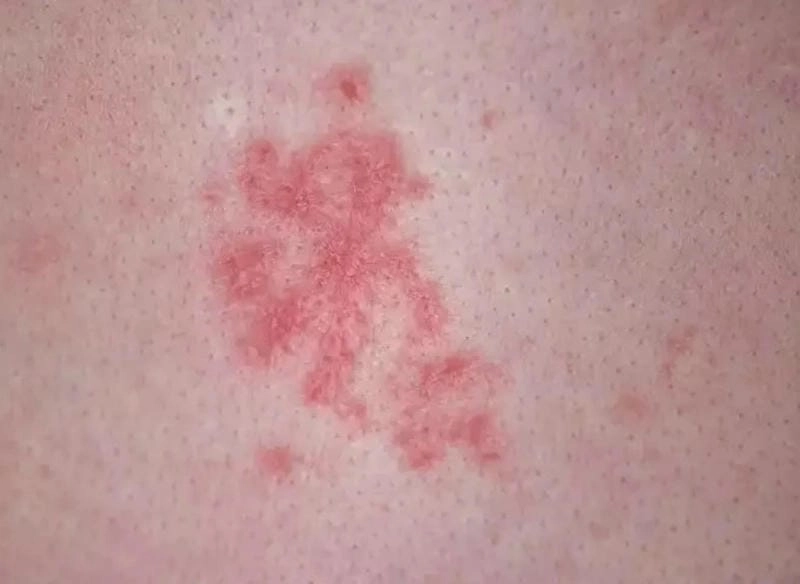 Xem đầy đủ các hình ảnh của bệnh lậu ở nhiều vị trí