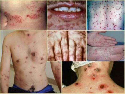 Cảnh báo với ảnh bệnh lậu ở nam rõ nét