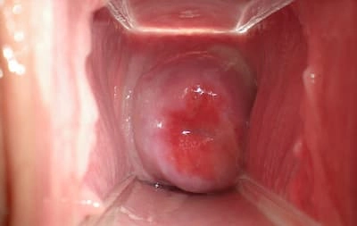 Xem ngay giai đoạn đầu giai đoạn đầu hình ảnh bệnh lậu ở nam