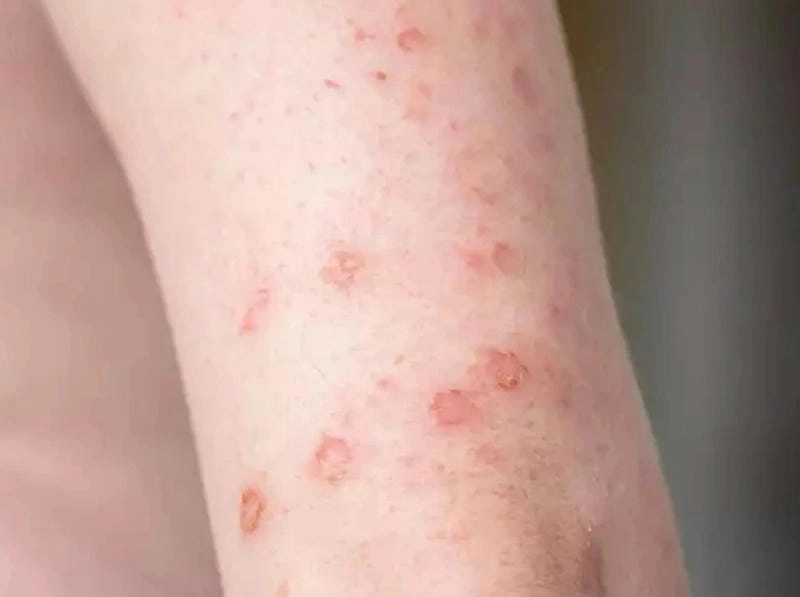 Nhận diện hình ảnh về bệnh lậu ở nữ giới dễ dàng