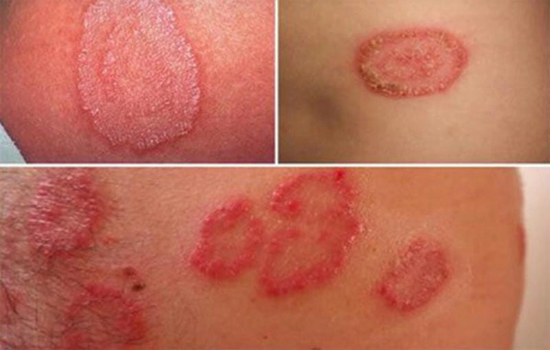 Tổng hợp chi tiết các hình ảnh bệnh lậu phổ biến nhất