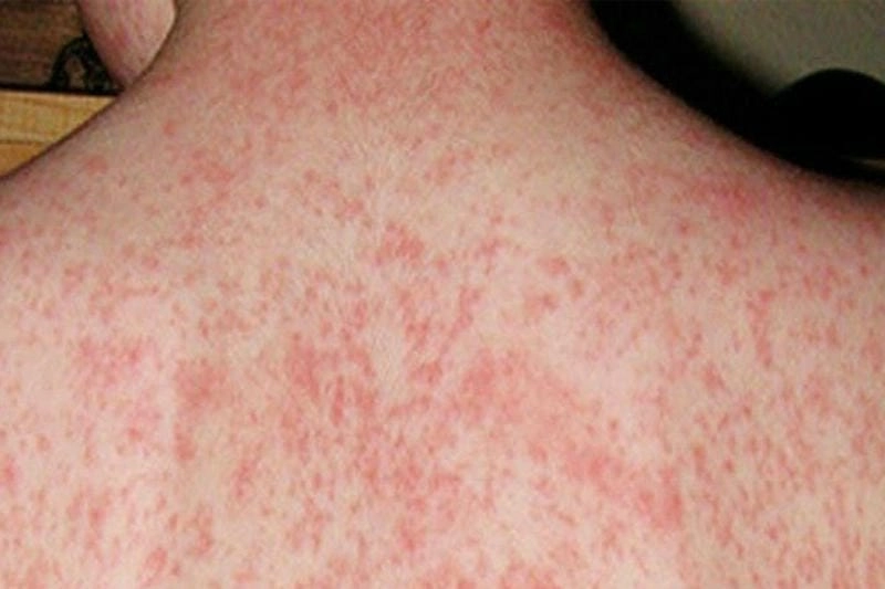 Phân biệt rõ hình ảnh bệnh lậu giang mai dễ gây nhầm lẫn