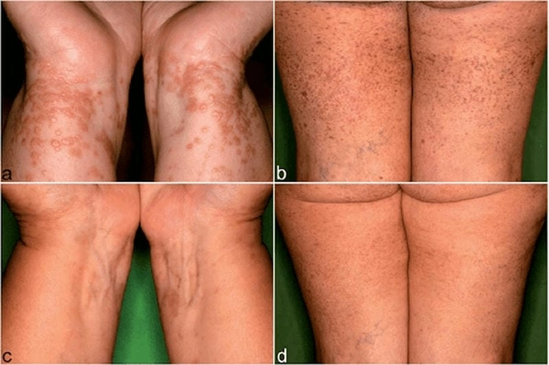 Hình ảnh bệnh lichen cho thấy rõ bệnh da lichen hóa