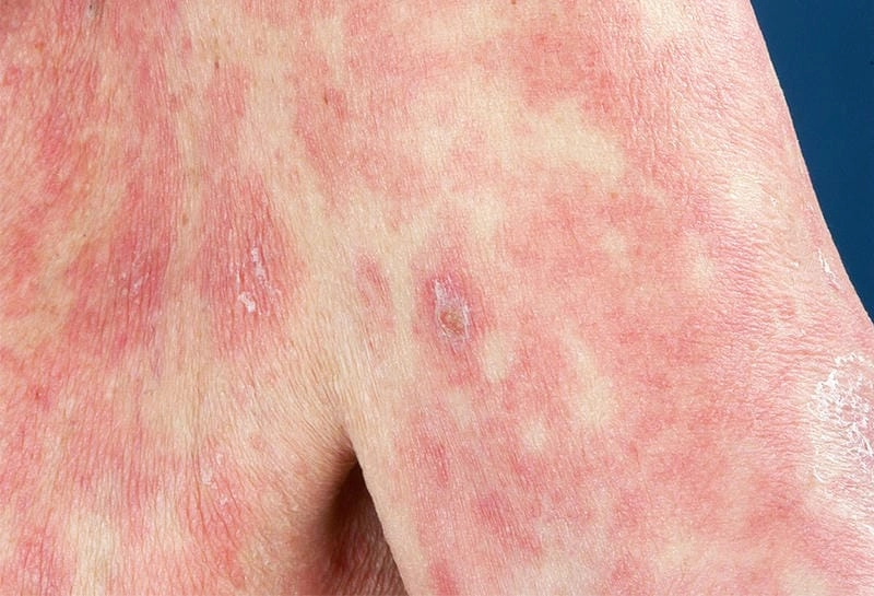 Khám phá hình ảnh bệnh lichen giúp hiểu lichen planus là bệnh gì