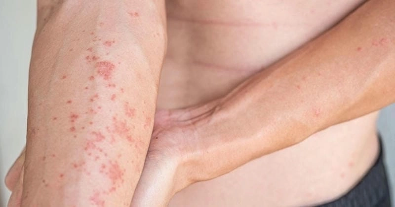 Hiểu nhanh lichen planus là gì qua hình ảnh bệnh lichen