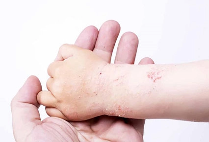 Tìm hiểu hình ảnh bệnh lichen qua trường hợp bệnh lichen nitidus