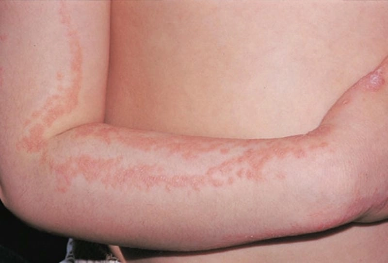 Hình ảnh bệnh lichen giúp phát hiện bệnh lichen dải