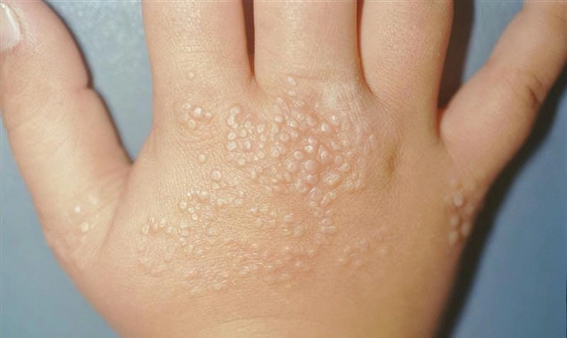 Hình ảnh bệnh lichen thường thấy trong bệnh lichen planus