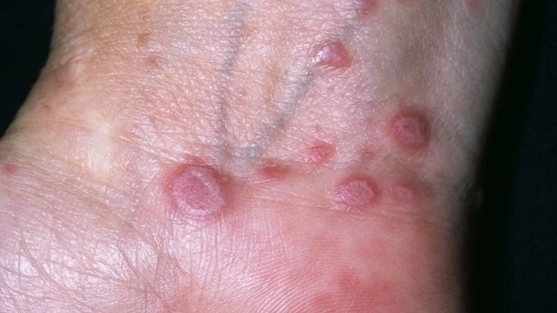 Xem rõ hình ảnh bệnh lichen và bệnh lichen hình chuỗi hạt