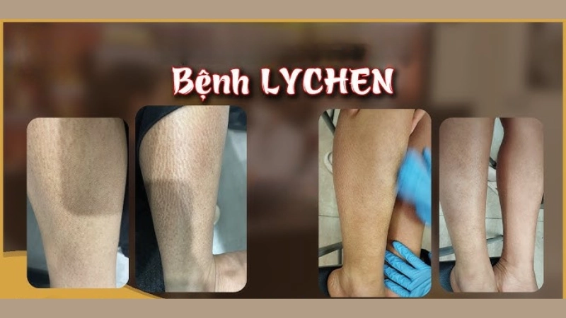 Tổng hợp hình ảnh bệnh lichen thường gặp trên da người