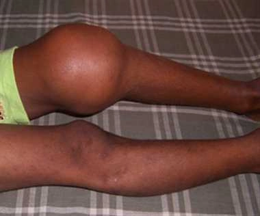 Cận cảnh hình ảnh bệnh máu khó đông đau lòng