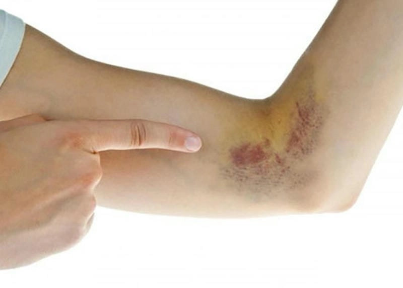 Phơi bày sự thật qua ảnh máu khó đông thực tế